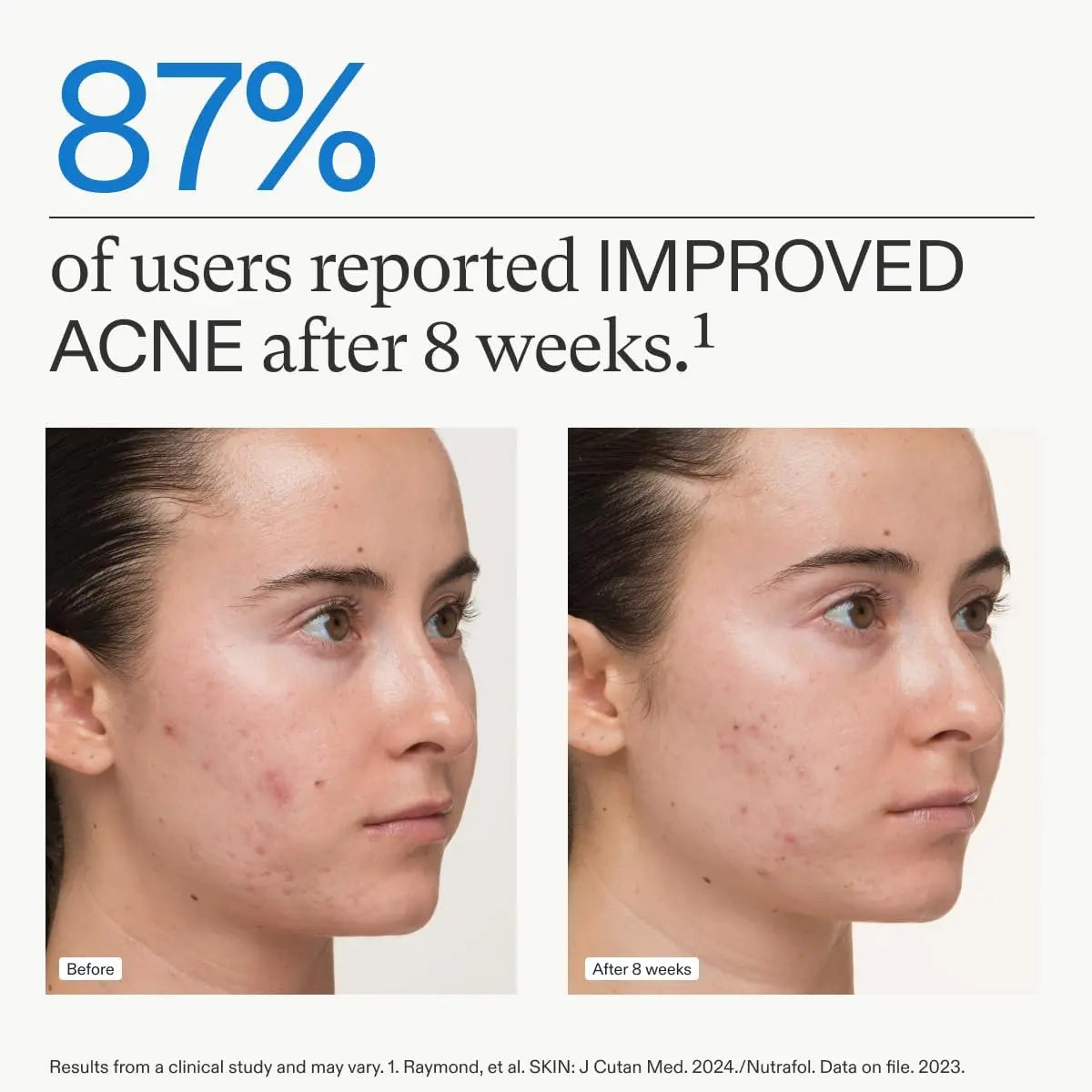 Nutrafol Clear Skin Nutraceutical Acne Supplement 3-Month Supply Nava Beauty